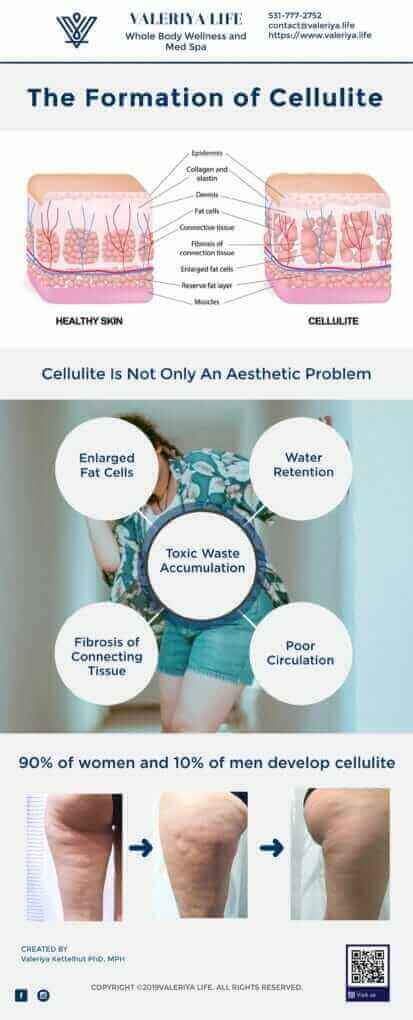 infographics for the formation of cellulite