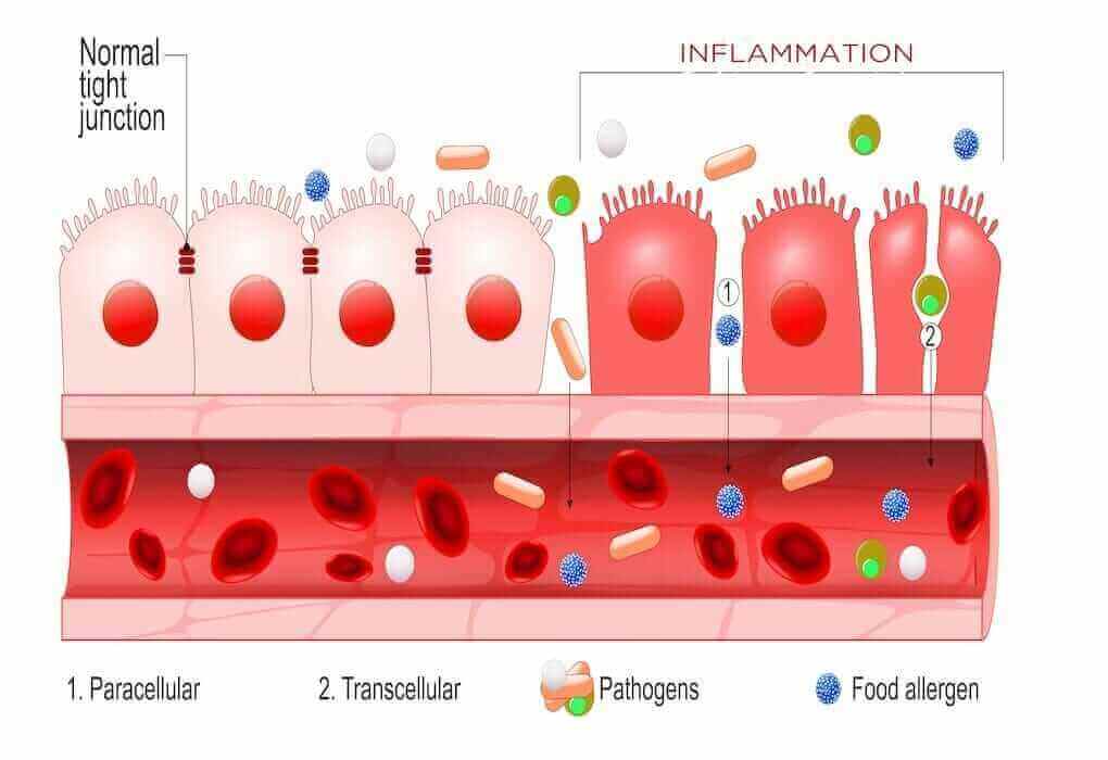 Leaky gut