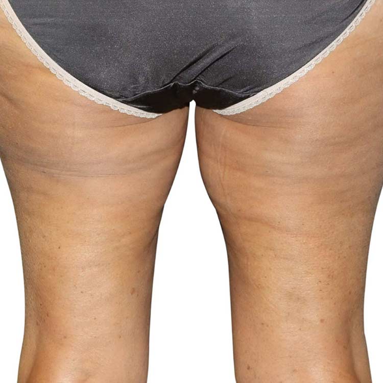 VenusLegacy cellulite after 2