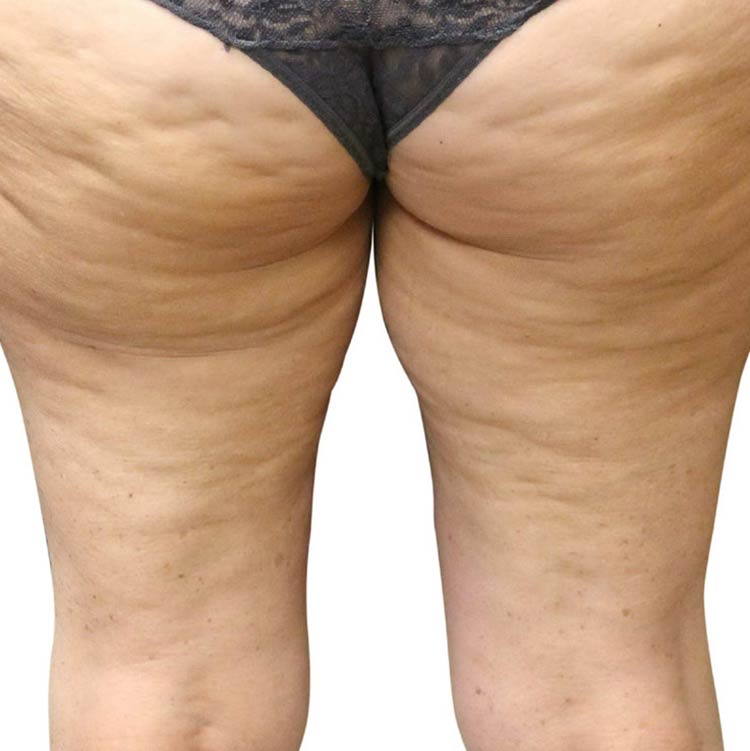 VenusLegacy cellulite before 2