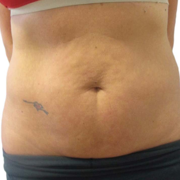 VenusLegacy cellulite before 3