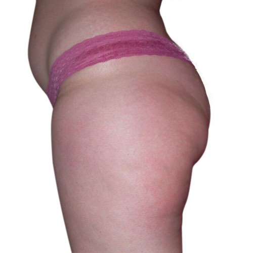 bliss fat reduction