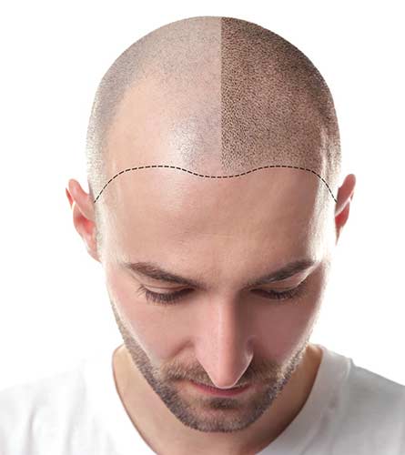 Scalp micropigmentationA