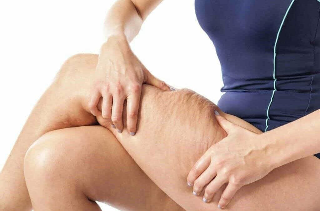 The Formation of Cellulite