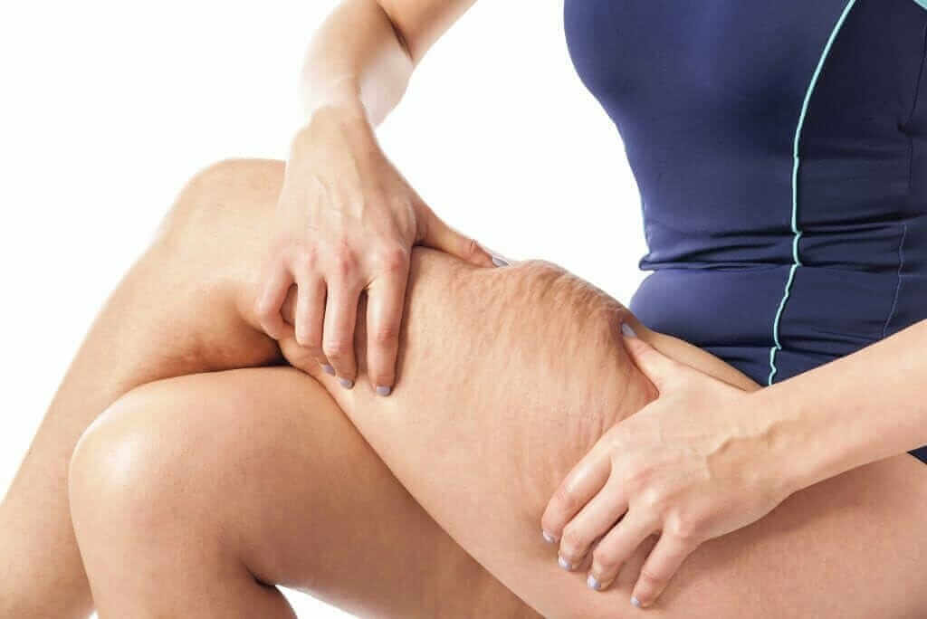 cellulite treatment