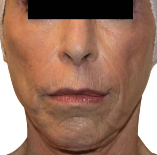 wrinkle reduction after treatment