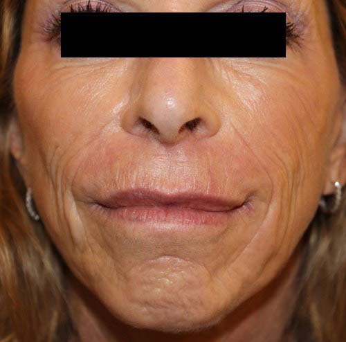 wrinkle reduction before
