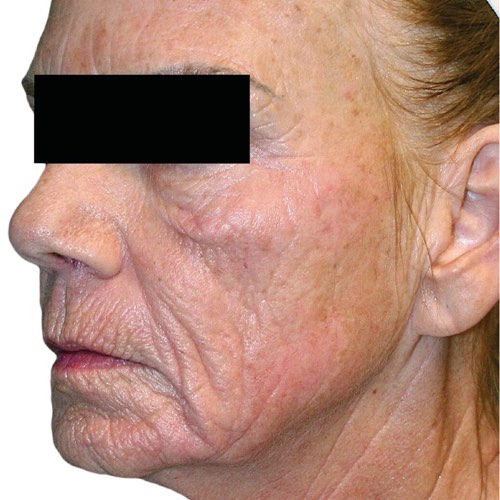 wrinkle reduction after treatment at Valeriya Life Medical Spa
