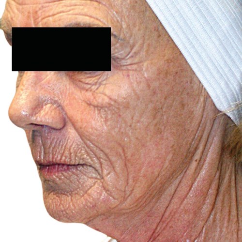 wrinkle reduction before treatment at Valeriya Life Medical Spa