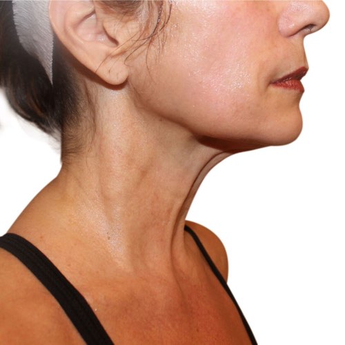 wrinkle reduction after treatment at Valeriya Life Medical Spa