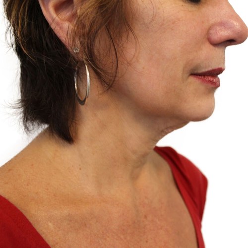wrinkle reduction before treatment