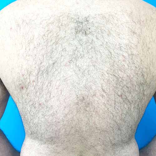 Hair removal before treatment