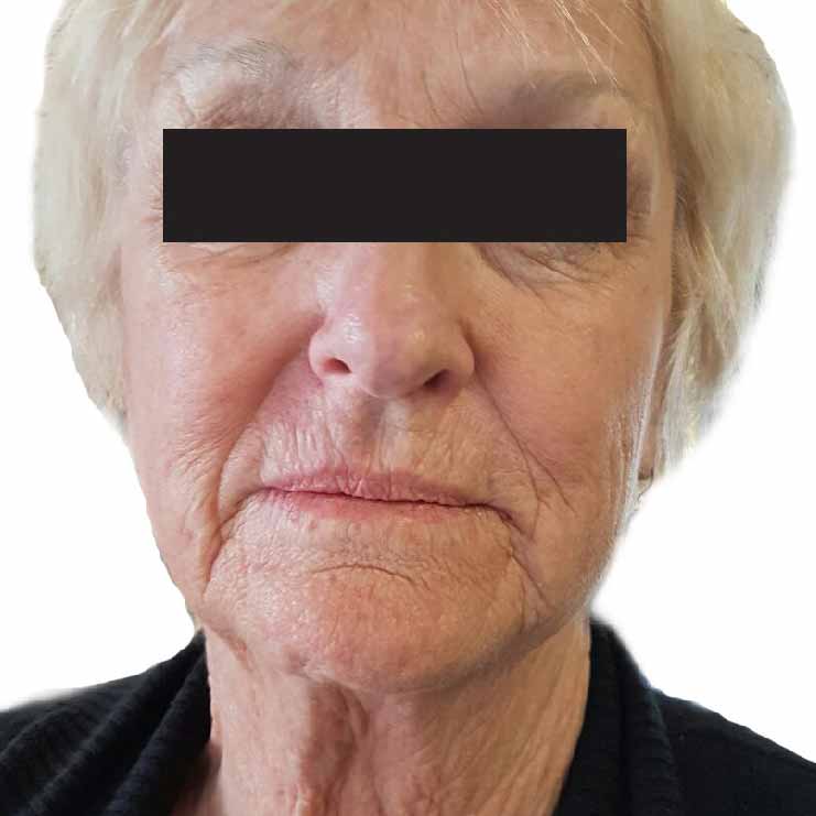 IPL before treatment