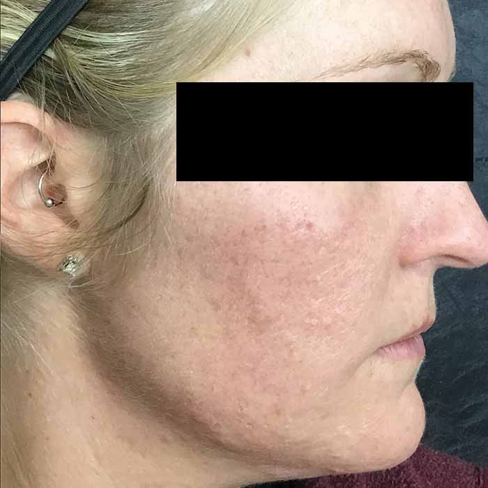 microneedling after3