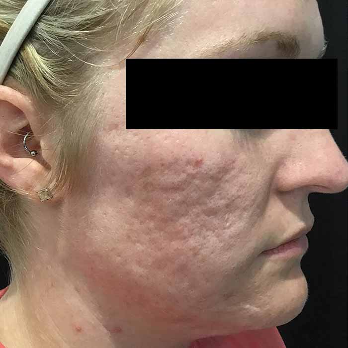 microneedling before3