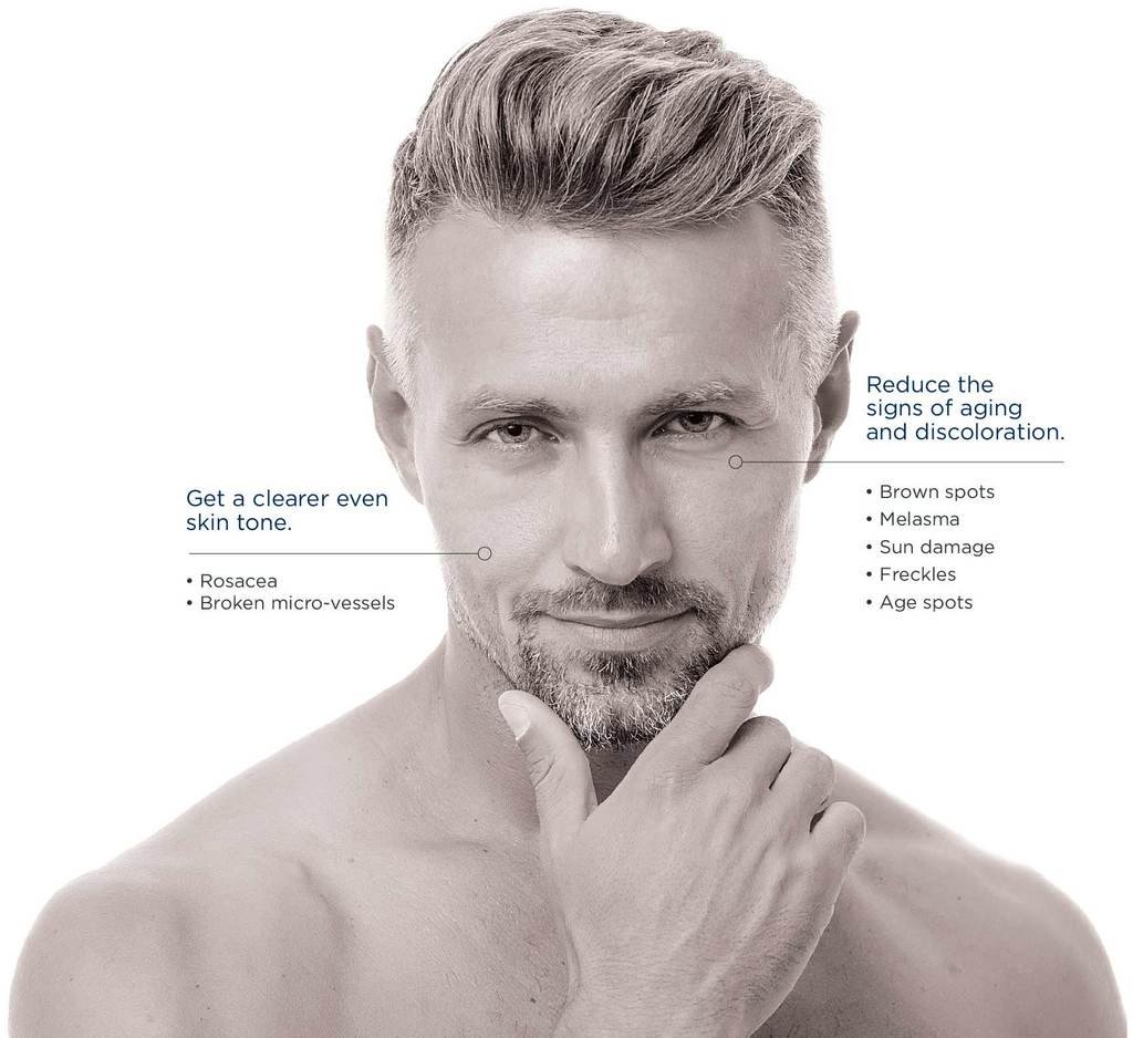 IPL Photorejuvenation