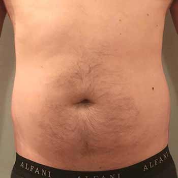 bliss after treatment