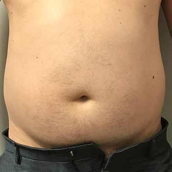 bliss before treatment