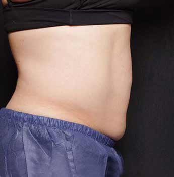 bliss after treatment