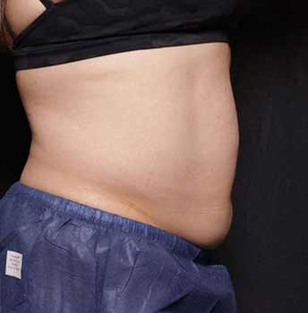 bliss before treatment