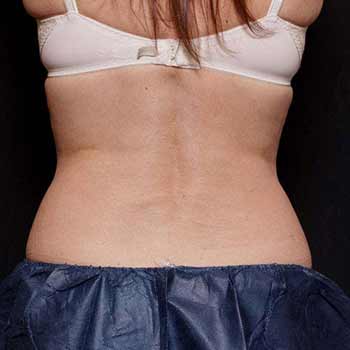 bliss after treatment