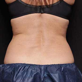 bliss before treatment