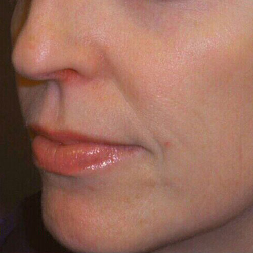 Tribella1 after