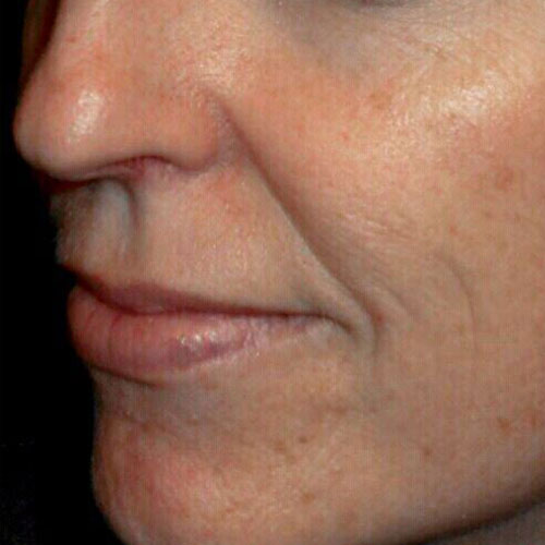 Tribella1 before