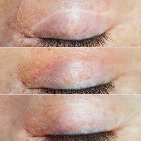 Eye scar treatment