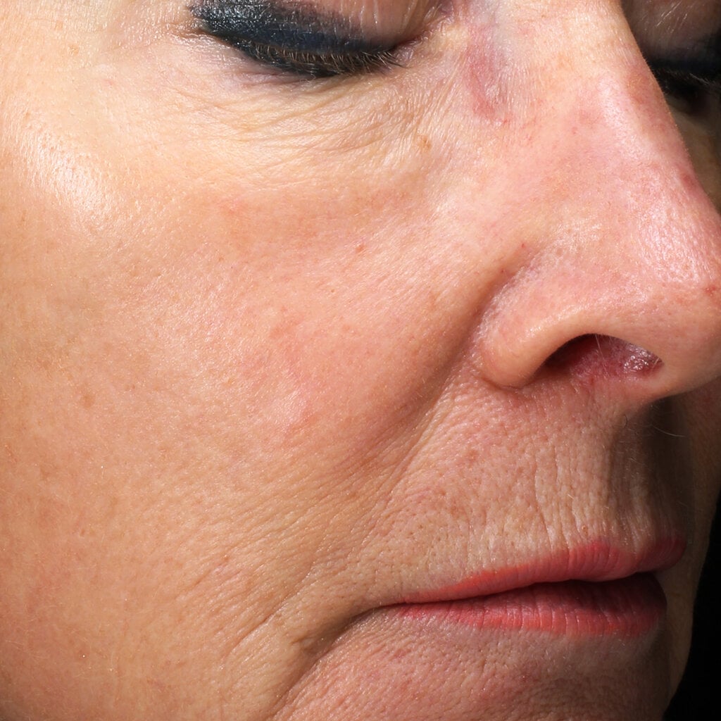 skin in woman after 3 treatments