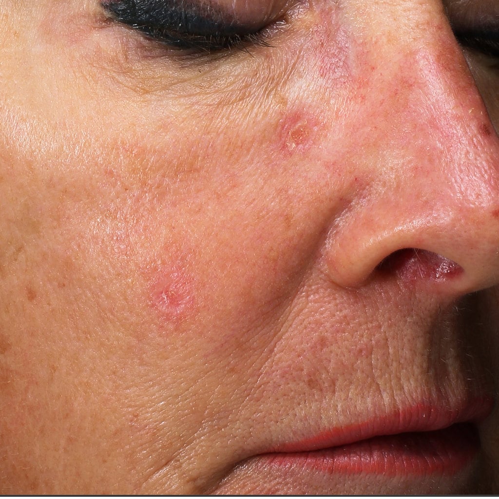 skin redness in woman before