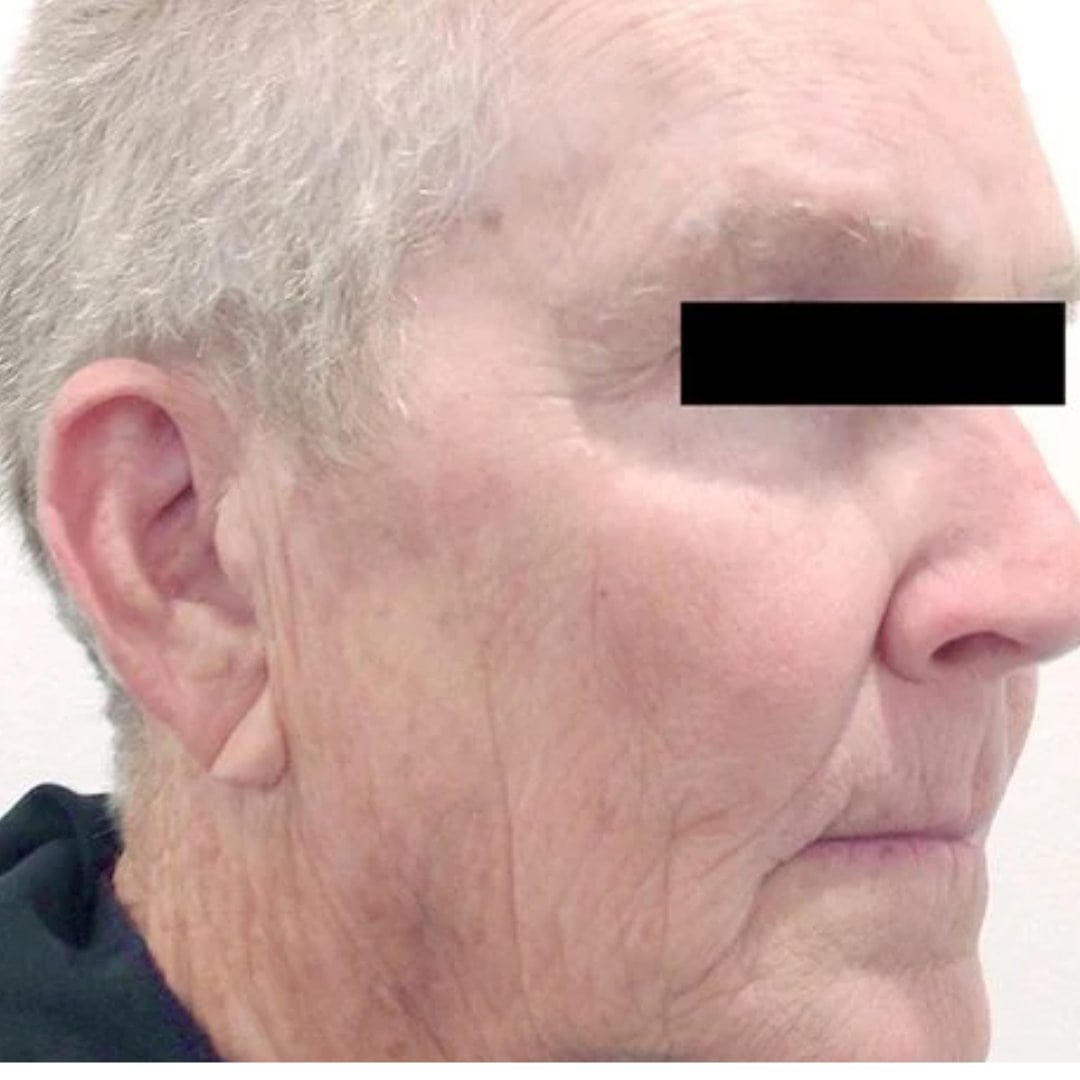 after tribella treatment