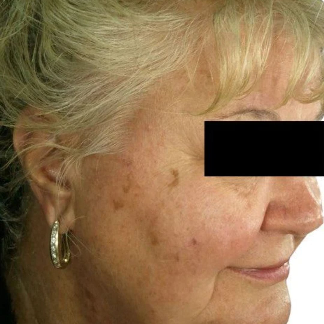 before tribella treatment