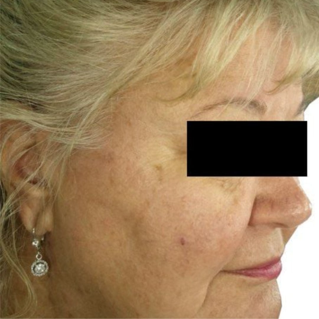 after tribella treatment